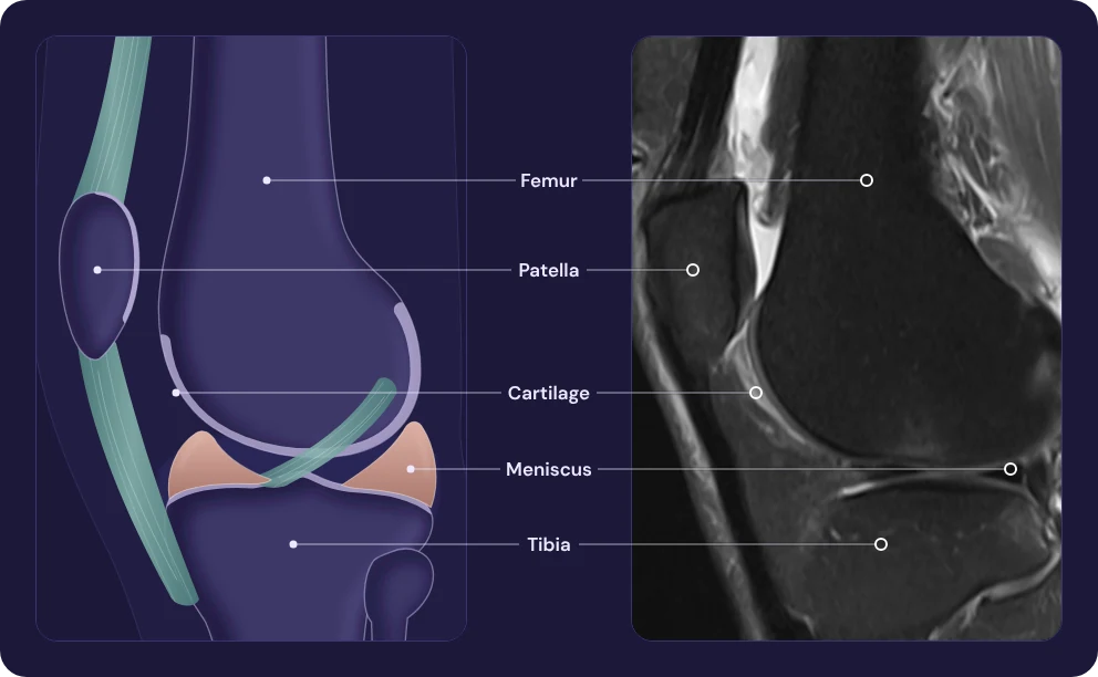 An illustration of the knee shown next to a real knee MRI, in the same side view. Labels point to the femur, patella, cartilage, meniscus and tibia on both images.