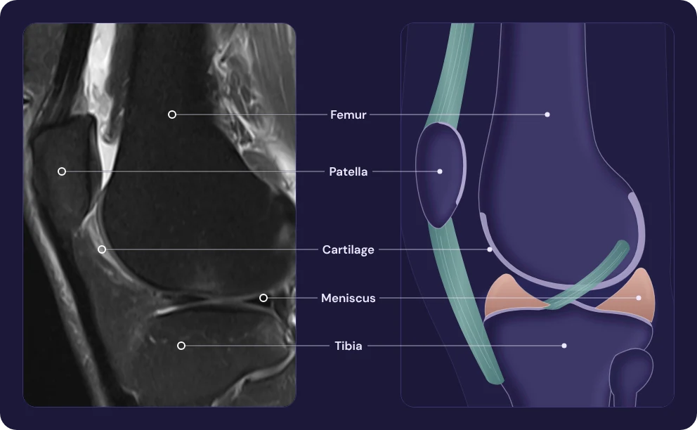 A real knee MRI shown next to a matching illustration of the knee, in the same side view. Labels point to the femur, patella, cartilage, meniscus and tibia on both images.